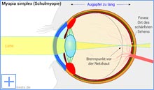 Myopia simplex (Schulmyopie)