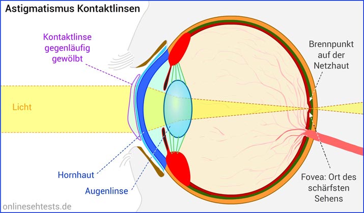 Kontaktlinse bei Astigmatismus
