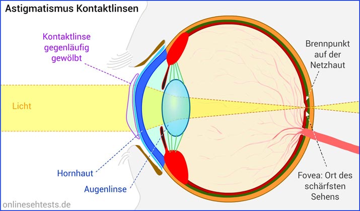 Bitte Anklicken zum Vergrößern Kontaktlinse bei Astigmatismus