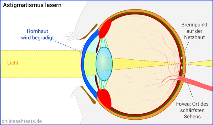 Bitte Anklicken zum Vergrößern Augenlasern bei Astigmatismus