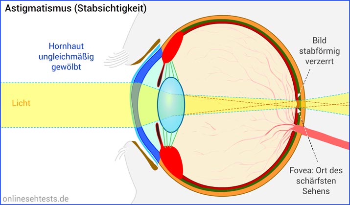 Bitte Anklicken zum Vergrößern Astigmatismus (Stabsichtigkeit)