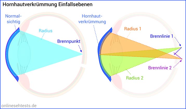 Bitte Anklicken zum Vergrößern Hornhautverkrümmung Erklärung: Einfallsebenen und Brennlinien