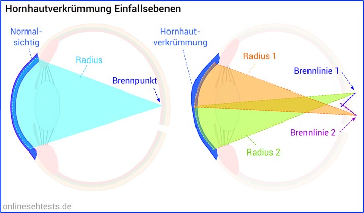 Astigmatismus (Hornhautverkruemmung) Einfallsebenen