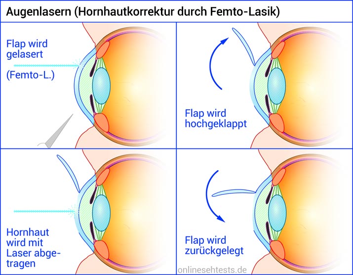 Augenlasern (Hornhautkorrektur mit Femto-Lasik)