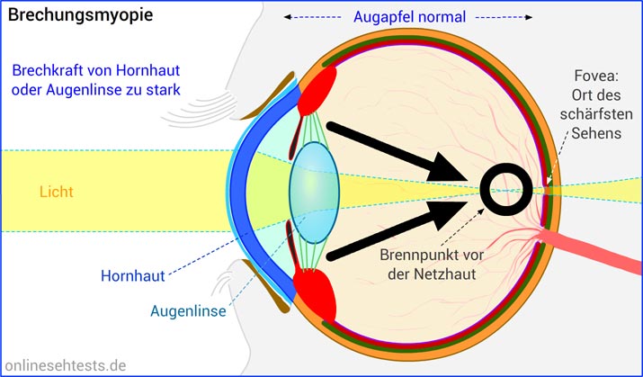 Brechungsmyopie