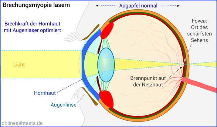 Bitte Anklicken zum Vergrößern Augenlasern bei Brechungsmyopie