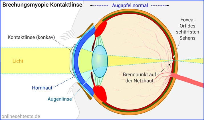 Bitte Anklicken zum Vergrößern Kontaktlinse bei Brechungsmyopie