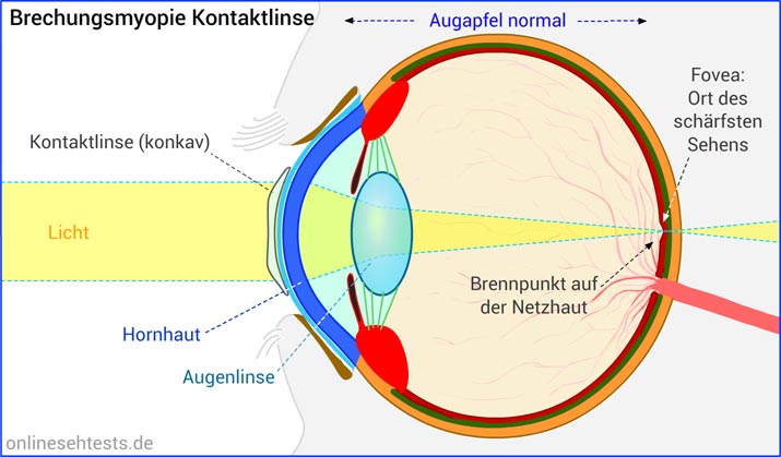 Kontaktlinse bei Brechungsmyopie