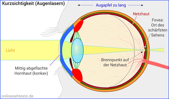 Kurzsichtigkeit lasern