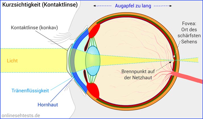Kontaktlinse bei Kurzsichtigkeit