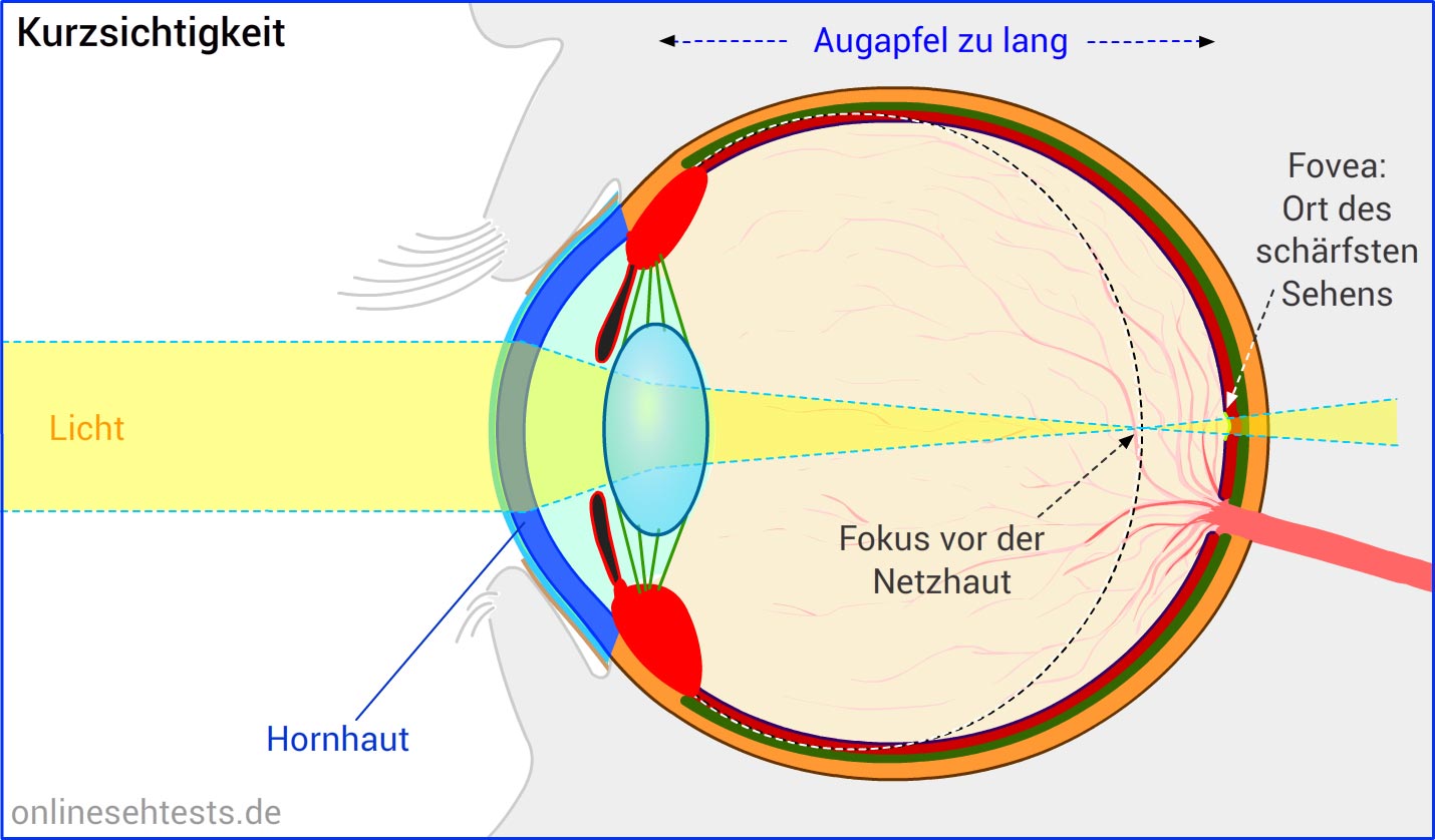 myopie astigmatismus presbyopie