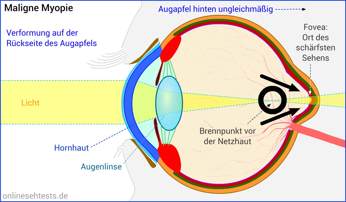 myopie astigmatismus presbyopie