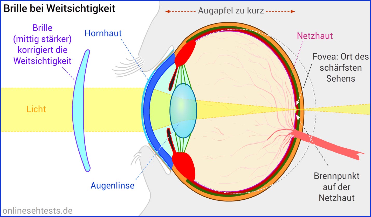 was ist hyperopie astigmatismus