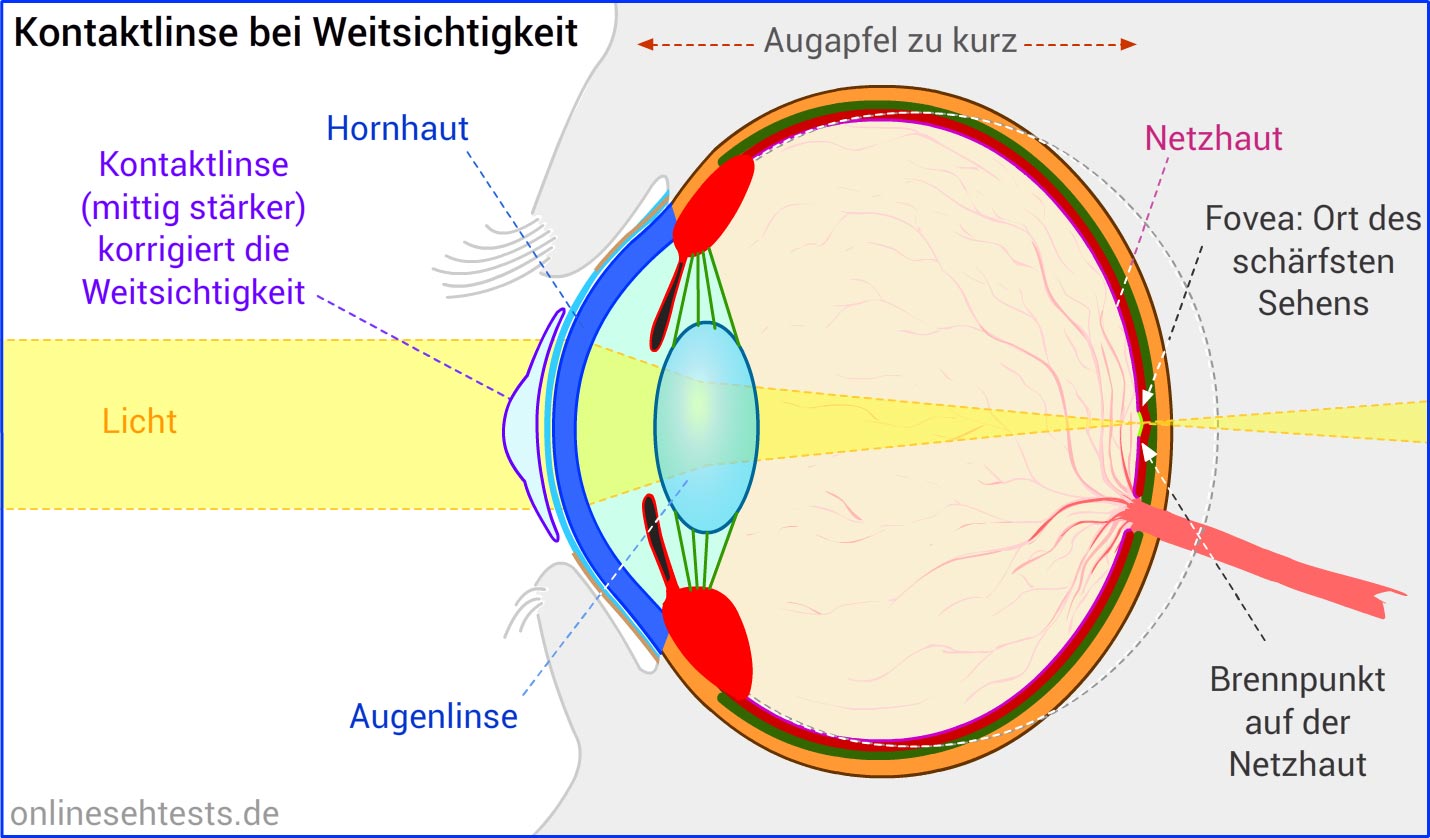 was ist hyperopie astigmatismus)