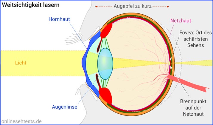 Weitsichtigkeit lasern